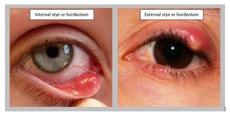 Internal Vs External Hordeolum