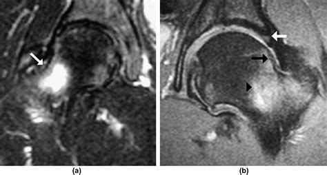 Femoroacetabular Impingement Bone Marrow Oedema Associated With