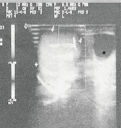 Ultrasound image of right testis with epididymal cyst * (on acute ...