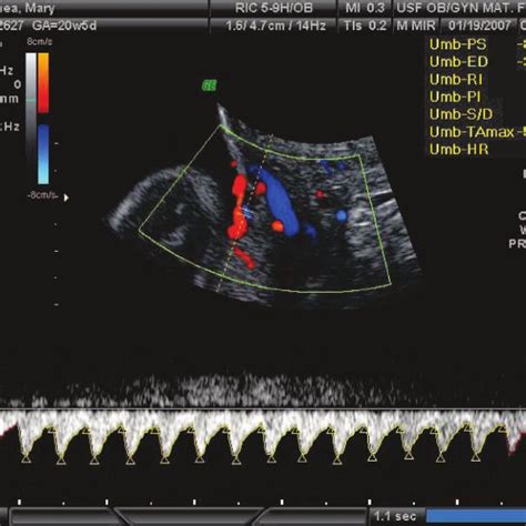 Endoscopic Visualization Of Type Ii Vasa Previa During Laser Ablation Download Scientific