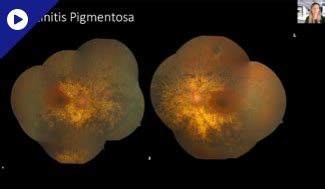 zeiss retina workflow retina today