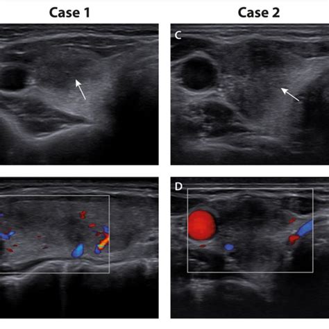 Thyroid Ultrasound A Case 1 Transverse View Of The Right Thyroid