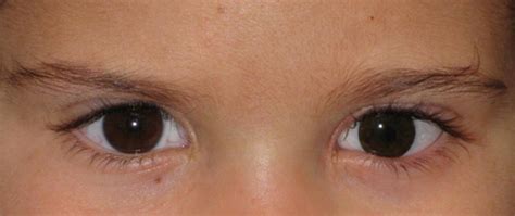 Congenital Microphthalmia And Congenital Cataract Dalpasso Protesi Oculari