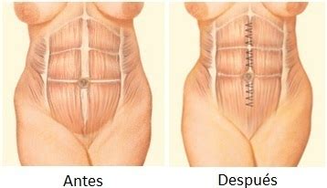 Abdominoplastia Consejos Y Resultados Sobre La Abdominoplastia