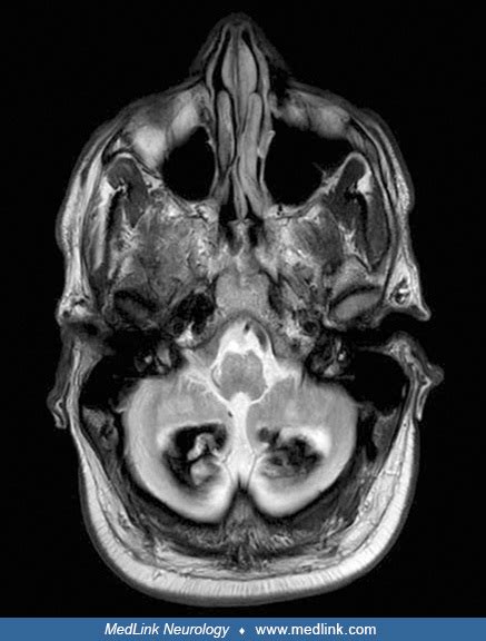 Cerebrotendinous Xanthomatosis Medlink Neurology