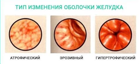 Субатрофический гастрит у женщин: лечение и симптомы