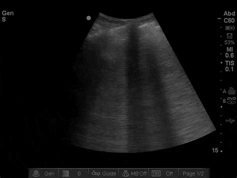 Pulmonary Edema Ultrasound