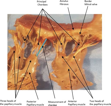 The Different Elements Of The Valve Principal Chordae Anterior And