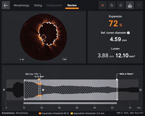 Intravascular Imaging Optical Coherence Tomography Oct Lightlab Outcomes Abbott