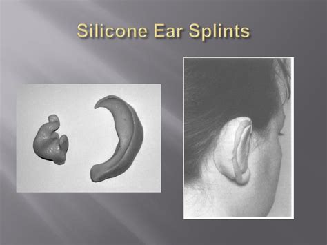 Ppt Management Of Auricular Hematoma Powerpoint Presentation Free