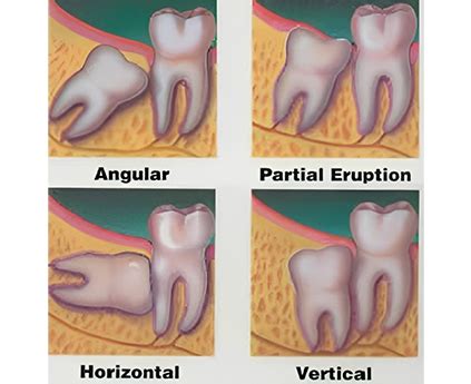 Wisdom Teeth Removal In Sydney Sydney Dental Surgeons