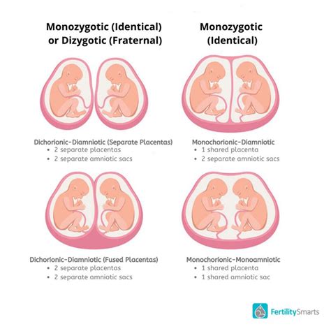 Dichorionic-Diamniotic Twins in 2024 | Medical illustration, Nursing ...