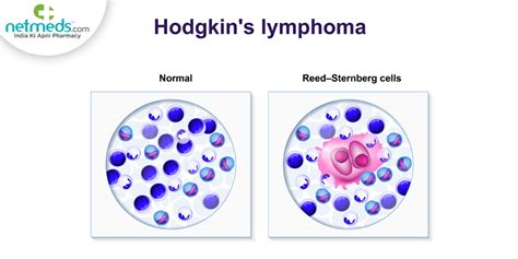 Lymphoma