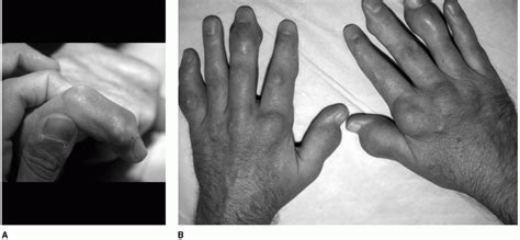 Gout Affecting the Hand and Wrist : JAAOS - Journal of the American Academy of Orthopaedic Surgeons