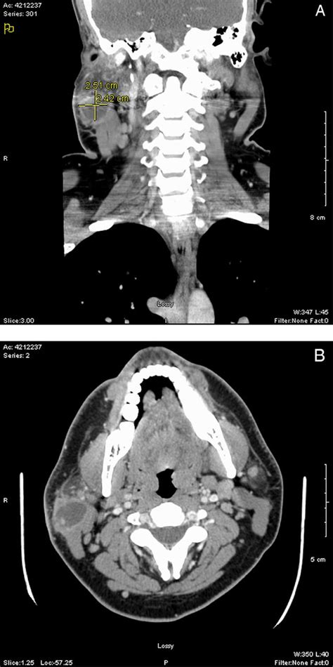 Acute Suppurative Parotitis Caused By Streptococcus Pneumoniae In An