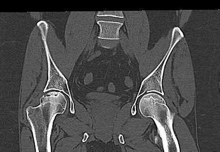 Avascular Necrosis Of The Femoral Heads Image Radiopaedia Org