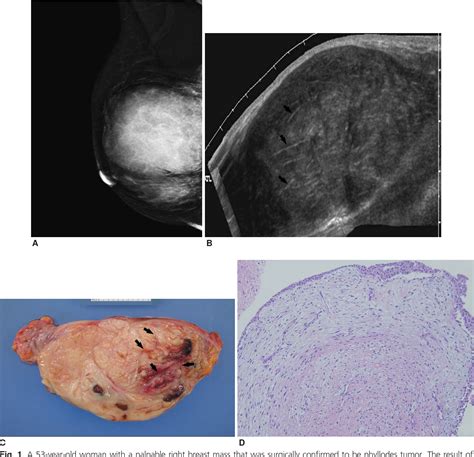 Figure 1 From Phyllodes Tumors And Fibroepithelial Lesions With