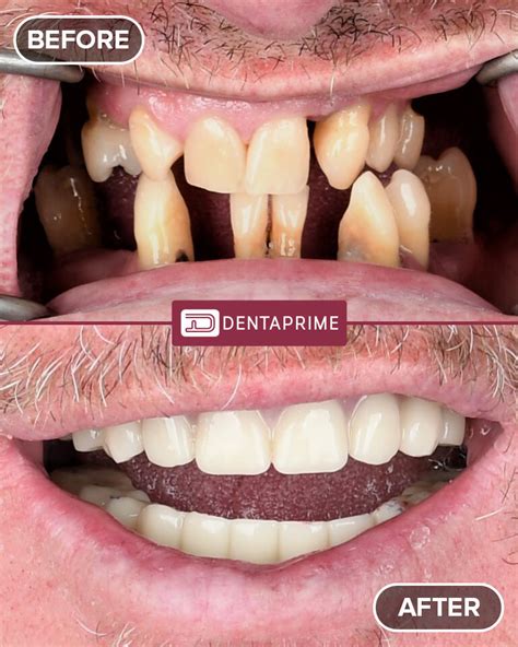 Fixed Teeth In A Day Same Day Implants Dentaprime UK