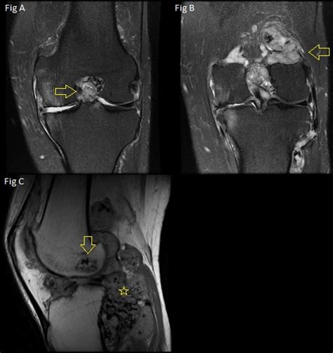 Sinovitis Vellonodular Pigmentada Diagnostico911 Org