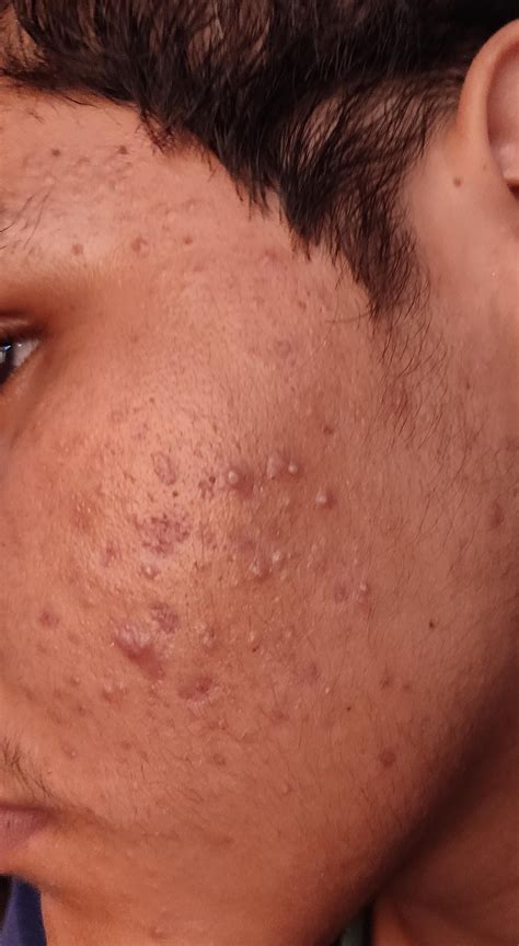 Is this fungal Acne? : r/Fungalacne