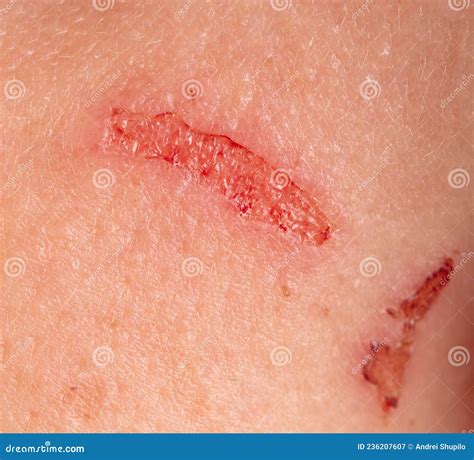 Close Up Wound On Human Skin Stock Image Image Of Accident Macro