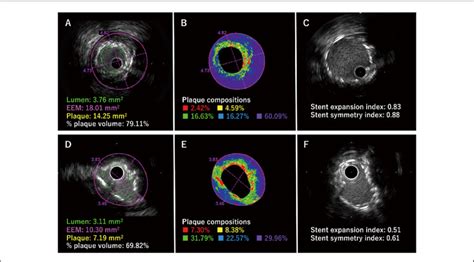 Representative Images Of Plaque Composition Evaluated By IB IVUS In The