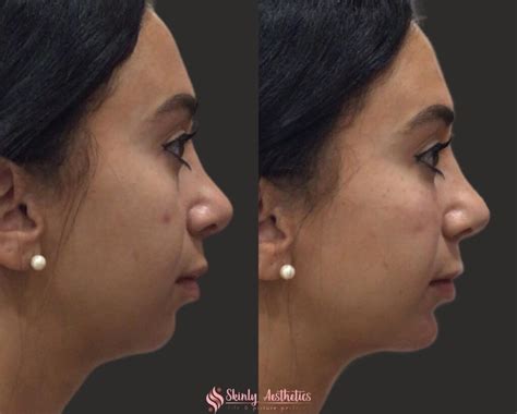 Chin Filler Injections Benefits Cost Results And Procedure Steps