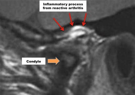 Diagnostic Imaging Of The Temporomandibular Joint Tmj Larry M