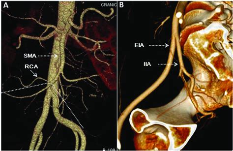 Preoperative D Reconstruction Of Ct Scan A Anatomy Of The Superior