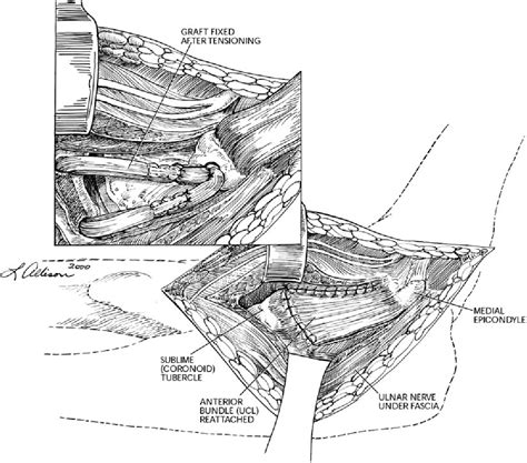 Figure 2 From Hybrid Technique Long Term Results Of Ulnar Collateral Ligament Reconstruction In