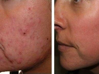 Clareador Virilha Cido Retinoico Peeling D Tca Brinde