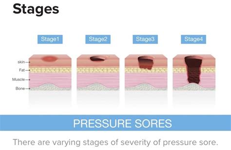 Bed Sores What We Should Know