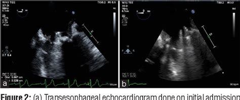 Figure 2 From Late Prosthetic Valve Infective Endocarditis By