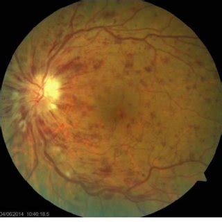 Fundus Photography Of The Left Eye Showing Central Retinal Vein