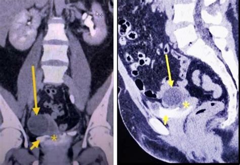 Cect Of The Abdomen And Pelvis Showing Contrast Extravasation From The Download Scientific