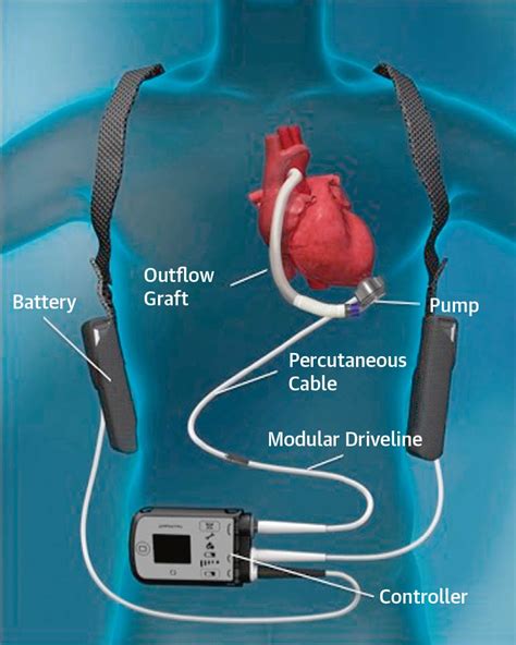 Bionic Women And Men Heart Failure And An Artificial Heart Pump