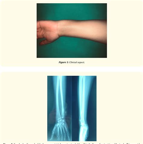 Figure From Osteoid Osteoma Of The Lower Extremity Of The Ulna A