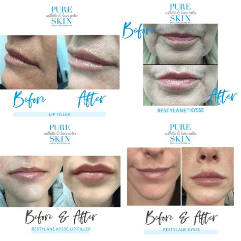 Restylane Before And After Lips