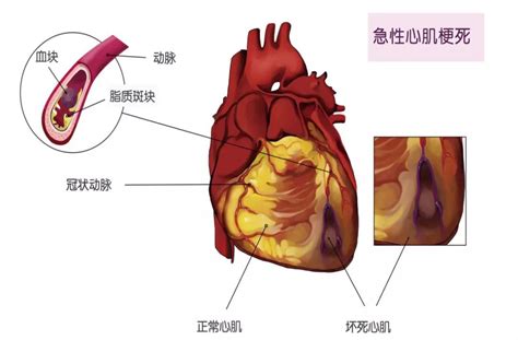 【话说胸痛】发生急性心肌梗死后该怎么办？重庆东华医院