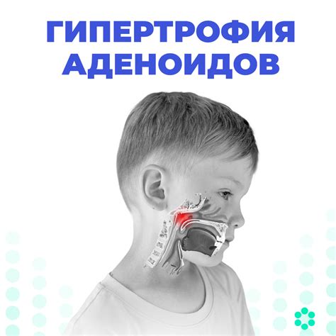 Гипертрофия аденоидов | МЦ ЛОРздрав