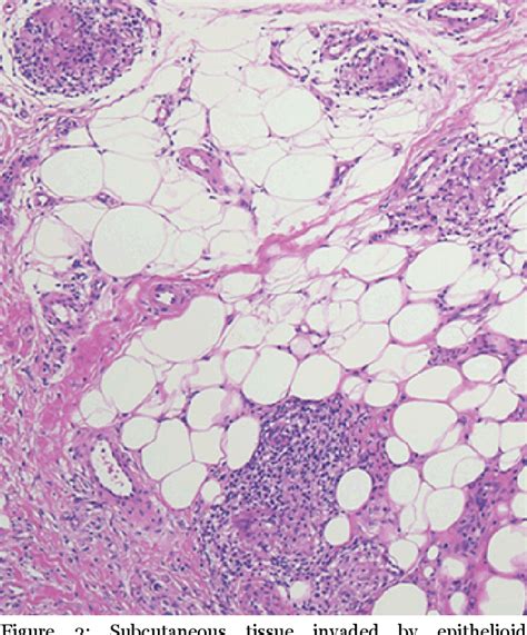 Figure From Cutaneous Sarcoidosis Presenting With Diffuse