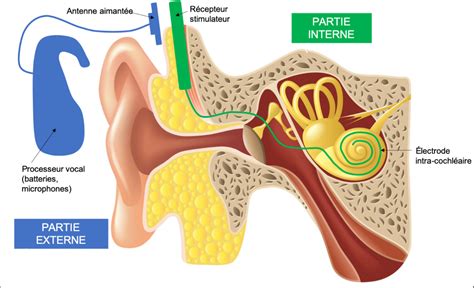 Trucs Mais Pas Astuce Limplant Cochl Aire La Solution Auditive