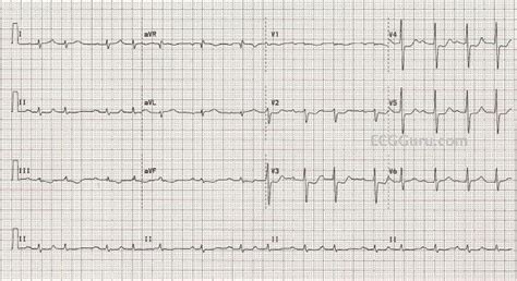 NSTEMI | ECG Guru - Instructor Resources