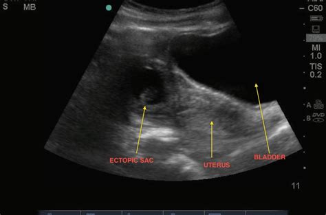 Ruptured Ectopic Pregnancy Ultrasound