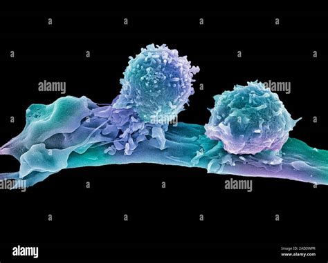 T Lymphocytes And Cancer Cell Coloured Scanning Electron Micrograph