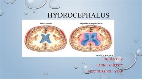 Hydrocephalus For Adult Ppt