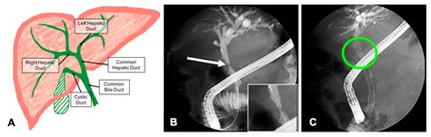 Common Bile Duct Model