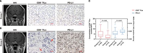 Frontiers Pd L1 And Tumor Infiltrating Cd8 Lymphocytes Are