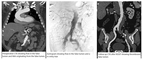 SCVS Re Entry Specific Endovascular Therapy RESET Of Chronic TBAD