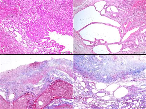 There is prominent foveolar hyperplasia (a, H&E, )100) and also marked ...